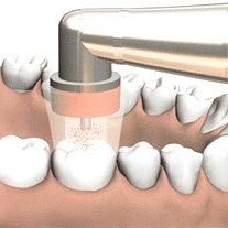 Ozonove osetrenie zubov v Kosiciach – STONEK