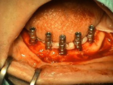 Proteticka liecba v bezzubej sanke nesena piatimi implantatmi - Stonek