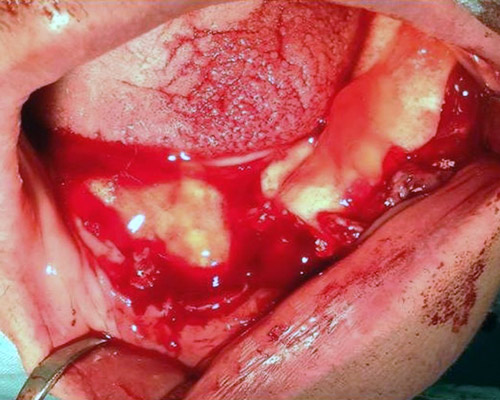 Chirurgicke zakroky zubnej ambulancie Stonek Kosice – doktor Kucera Jan