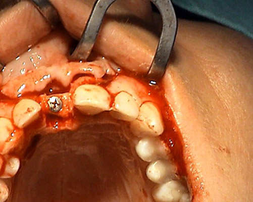 Dentoalveolarna chirurgia – Stonek s.r.o. – MUDr. Kucera Jan