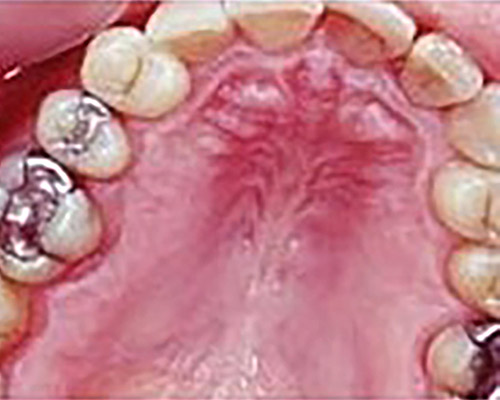 Konzervacna stomatologia – zubne kazy – Stonek – Kucera