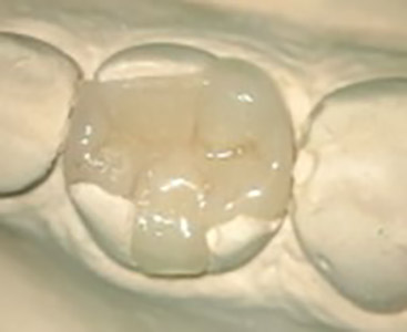 Oprava zubnych kazov – Kosicka ambulancia Stonek