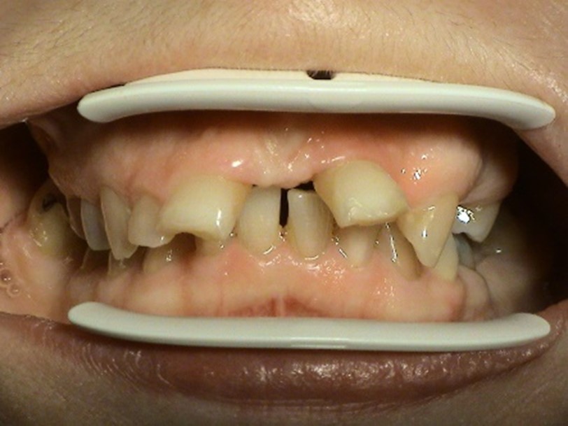 Proteticka liecba destruovanych zubov Stonek