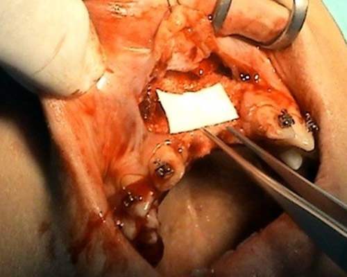 Spracovanie autologneho dentinu na tvorbu kosti po implantacii – Stonek Kosice