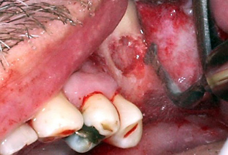 Uplatnenie v stomatologickych mnohych zakrokoch vyuziva piezochirurgia – Stonek