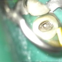 implantologia s mikroskopom - Stonek sro Kosice - MUDr. Kucera Jan