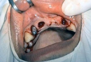 Frontálny defekt a celustnoortopedicka anomalia - implantologia Kosice - MUDr. Kucera Jan