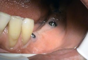 Implantacia zadných bezzubých úsekov v sánke - stomatolog Kosice - Kucera Jan
