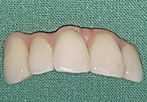 Implantaty - zubna ambulancia Stonek Kosice pre Vás