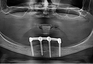 Rontgen implantatu v zubnej ambulancii Stonek Kosice - MUDr. Kucera Jan
