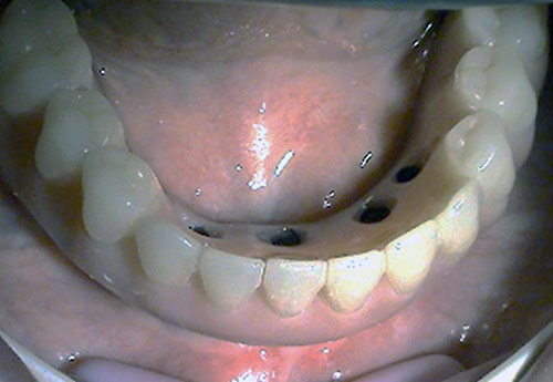 Stonek - implantologia zubnej ambulancie MUDr. Kuceru Jana Kosice